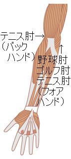 肘のスポーツ障害