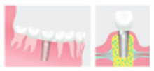 implant