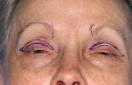 ���ض��ڽ�http://www.blepharospasm.org/apraxiaf8.html