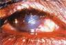 trachoma