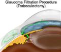 trabeculectomy