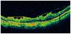 macular pucker OCT