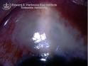 burebitis
