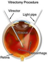 vitrectomy