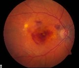wetmacular neovascularization