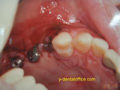 implant-5