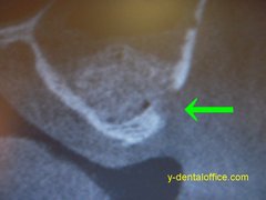 implant-1