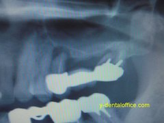 implant-4