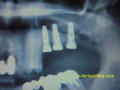 implant-3