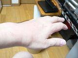 痛風再発
