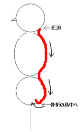 尾骨骨折による後頭骨圧迫