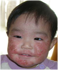アトピー画像生後1歳2ヶ月