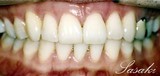 Essix治療後1