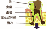 感染根管1