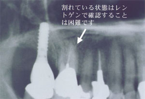 抜歯即時6
