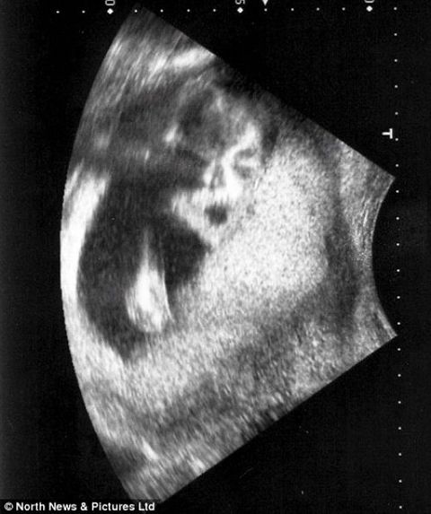 mj-in-womb